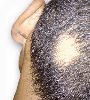 Alopecia Areata