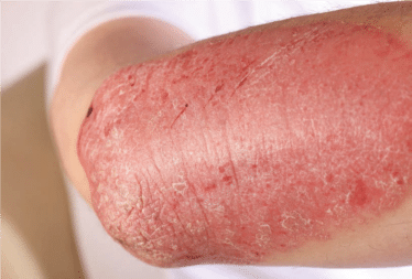 Psoariasis
