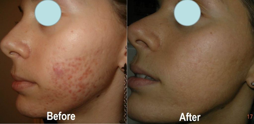 Before and After Fractora Treatment