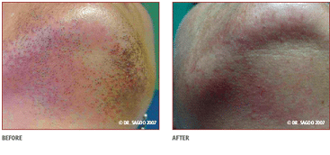 Chin Laser Hair Removal
