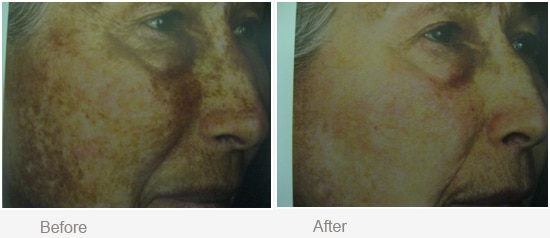 Before and After Hyperpigmentation Treatment