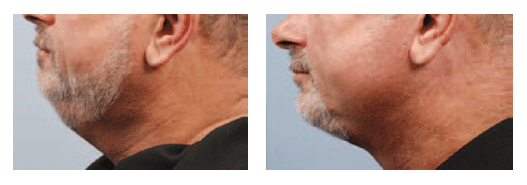 Before and After Neck Tightening