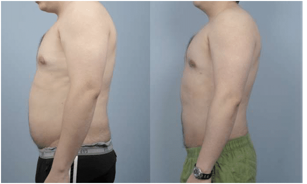 Before and After Fractora Treatment