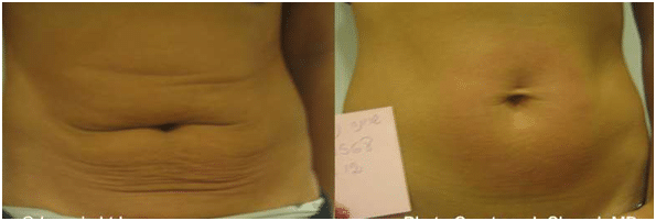 Before and After Fractora Forma Treatment