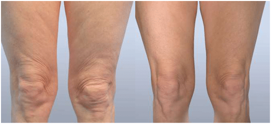 Before and After Fractora Forma Firm Plus