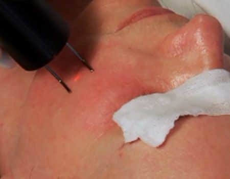 Process of Thread Vein Removal