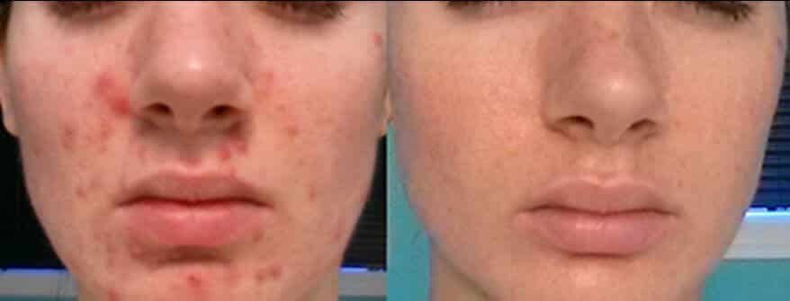Before and after Fractora Active 4 Treatments