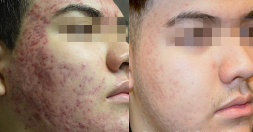Before and after Fractora Active Treatments